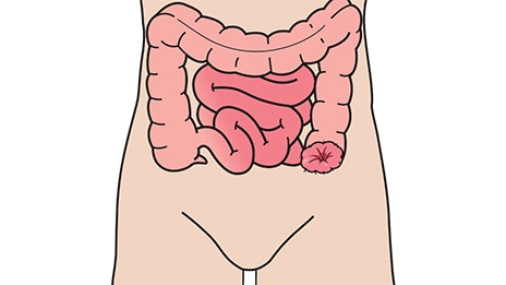 결장루란 무엇인가?
